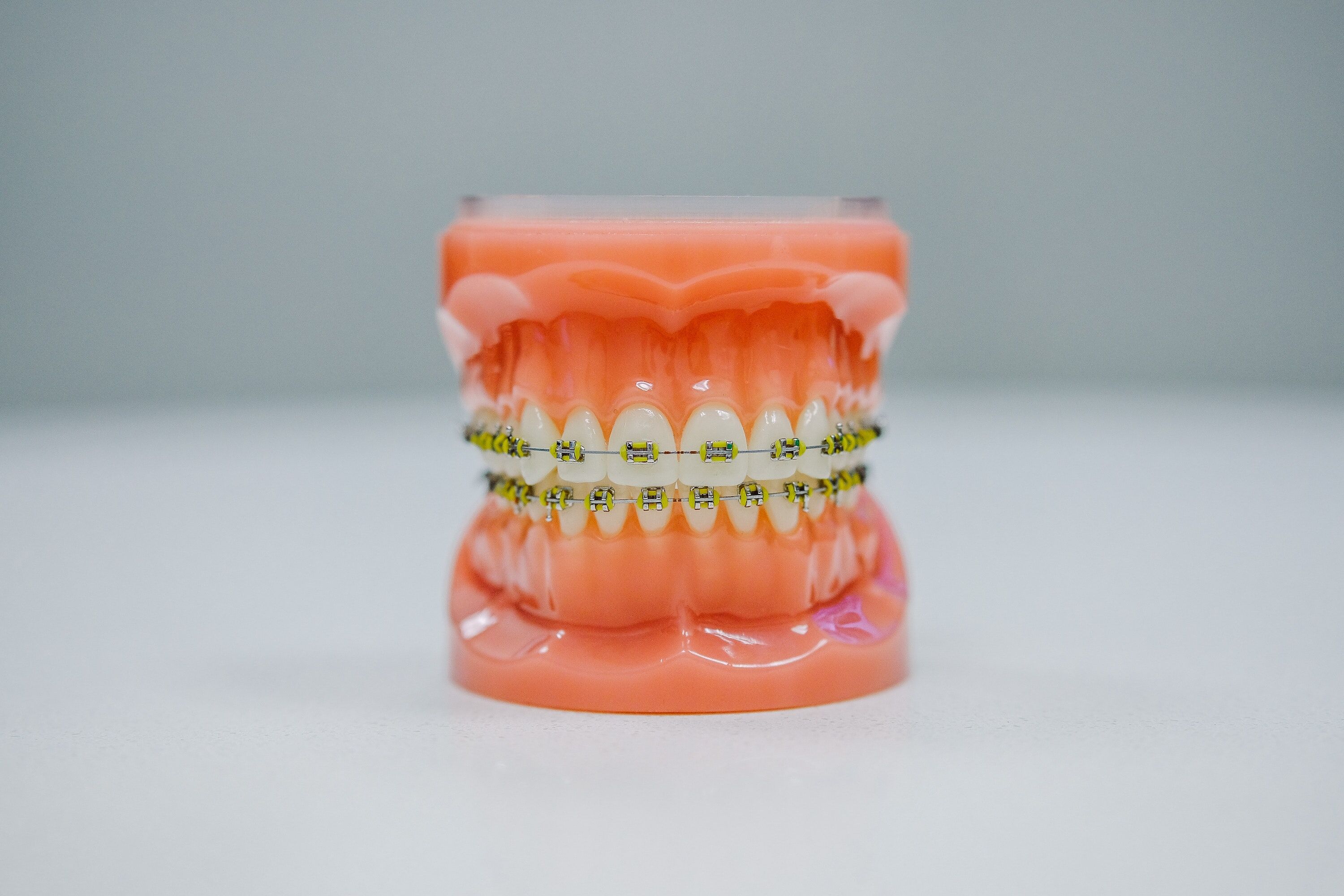 The Pros and Cons of Ceramic Braces - Orange Coast Orthodontics