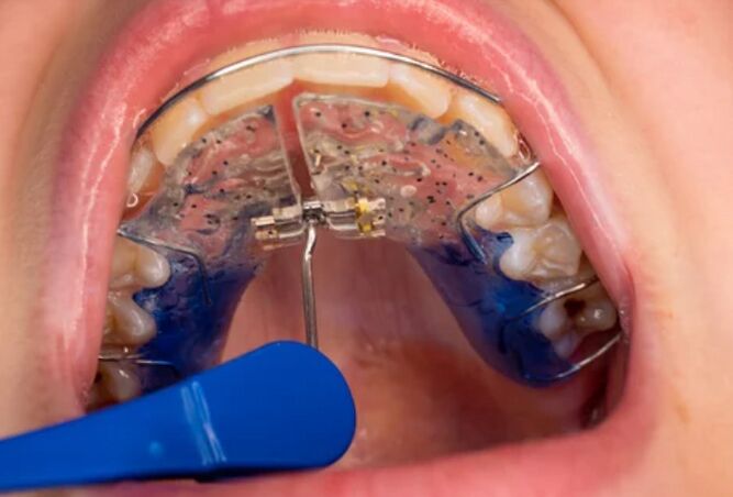 Braces Guide: Should I Wear My Retainer if It's Tight?