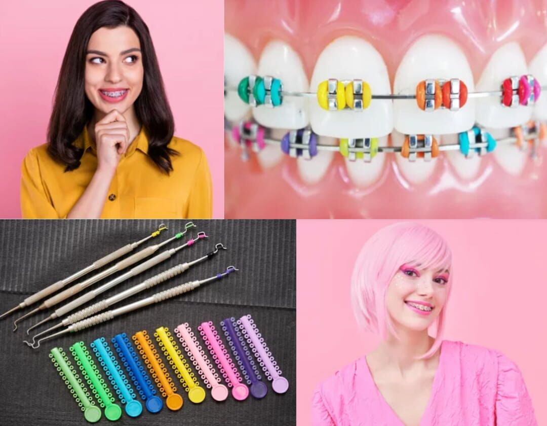 Types of Rubber Brands for Braces and Their Functions