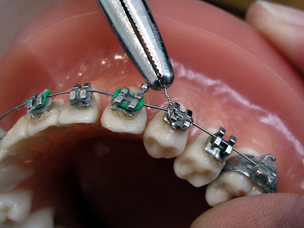 What Do Rubber Bands Do on Braces? - OC Dental Center